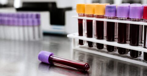 Cancerul pancreatic, detectat mai fin cu un nou test de sânge. Ce ar putea schimba pentru monitorizarea pacienților
