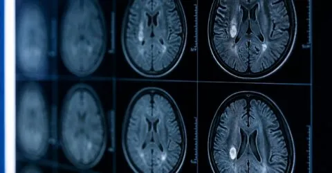 Un nou studiu schimbă percepția asupra AVC-ului lacunar