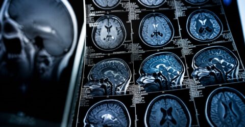 Un program de 10 săptămâni a redus ceața cerebrală din Long COVID