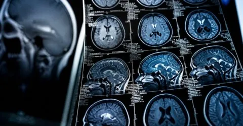 Un program de 10 săptămâni a redus ceața cerebrală din Long COVID