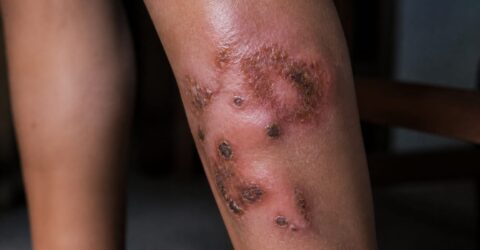 87 de cazuri în Europa cu Dermatophilus congolensis. Cum recunoști leziunile de piele și când e bine să mergi la medic