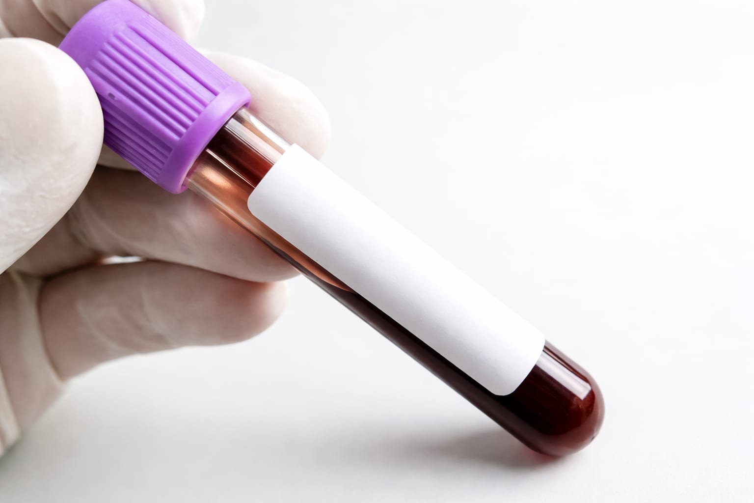 hemoglobină glicată, imagine 2
