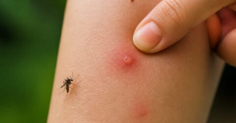 Scărpinatul după înțepătura de țânțar prelungește mâncărimea până la o săptămână