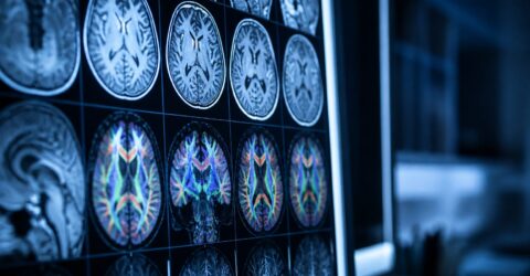 Cum ar putea fi prevenit Alzheimerul înainte de simptome. Noua pistă urmărește inflamația din creier