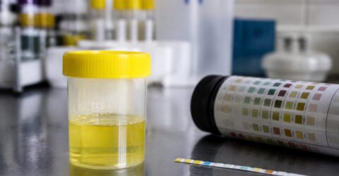 Proteinele în urină nu înseamnă mereu boală. O valoare de sub 1g/zi poate reveni la normal după o schimbare de stil
