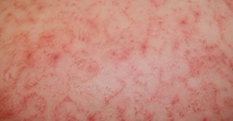Rujeola lovește iar în SUA. Numărul cazurilor a urcat la 2.295 până luni, 21 iulie, cel mai ridicat nivel din ultimii