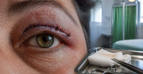 Scoaterea firelor acasă după blefaroplastie poate provoca infecții și poate crește riscul de redeschidere a rănii