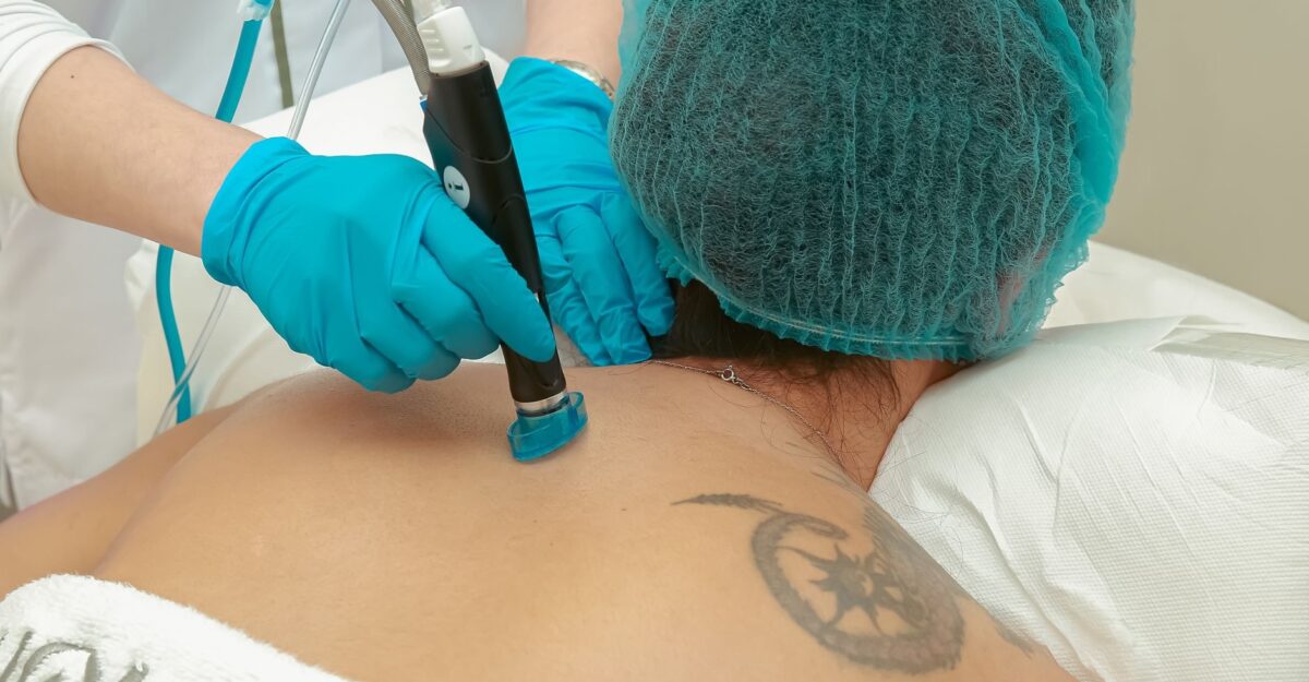 Ce trebuie să știi înainte să scoți un tatuaj cu laser. Pot fi necesare 6-8 ședințe cu pico laser
