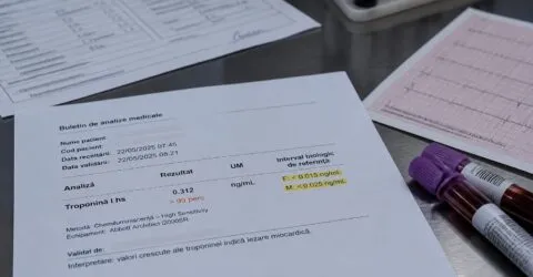 De ce pot fi ratate mai ușor unele infarcturi la femei? Un nou criteriu schimbă felul în care sunt citite analizele