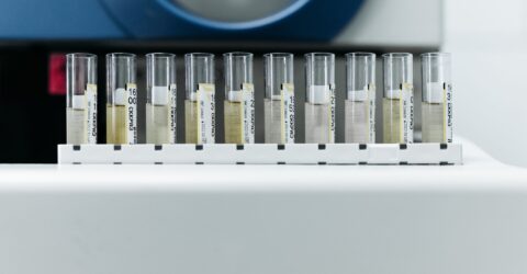 Infecțiile urinare recurente nu se tratează automat cu antibiotice. Când e nevoie de urocultură și alte verificări