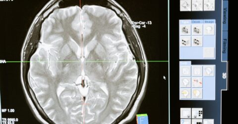 Menopauza nu pare legată de o nouă scădere a materiei cenușii, arată un studiu cu 1.095 de scanări cerebrale