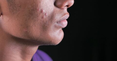 Cum tratezi acneea după adolescență. Semnele pentru care ai nevoie de dermatolog și limitele plasturilor pentru coșuri