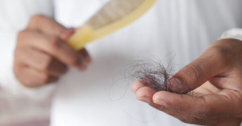 Analizele hormonale normale nu exclud alopecia la femei. Ce semne cer investigații suplimentare