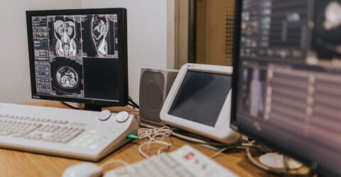 Femeile cu sâni denși au un risc de cancer mamar de 1,7 ori mai mare, arată un studiu